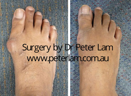 Bunion Surgery Before & After Gallery